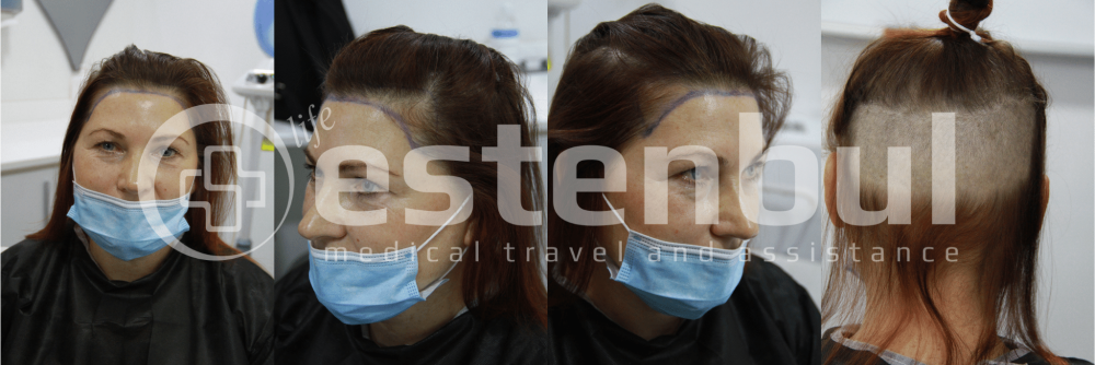 hair transplant before.png