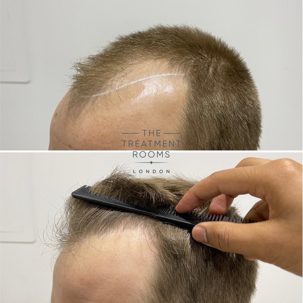 hair transplant clinic london 1756 grafts before and after.jpg