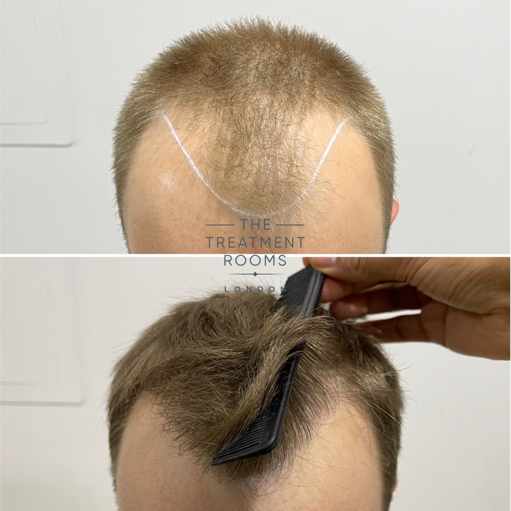 hair transplant clinic london 1756 grafts result.jpg