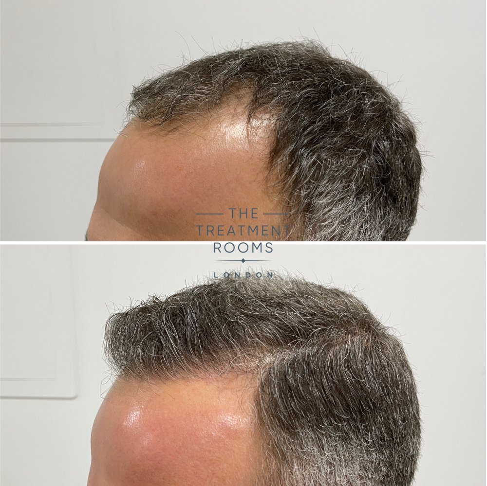 hair transplant clinic london 1788 grafts hairline before and after.jpg