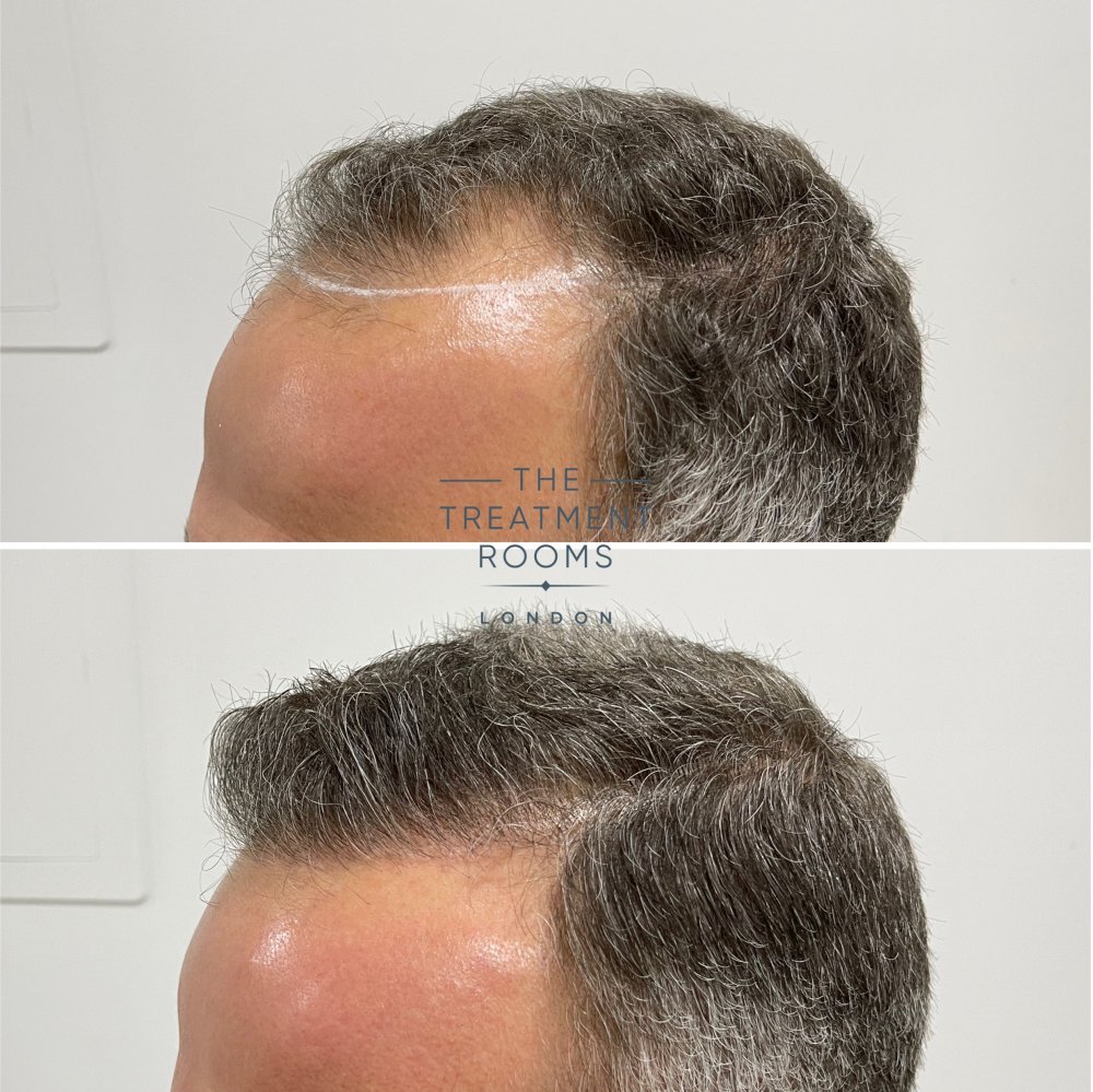hair transplant clinic london 1788 grafts hairline result.jpg