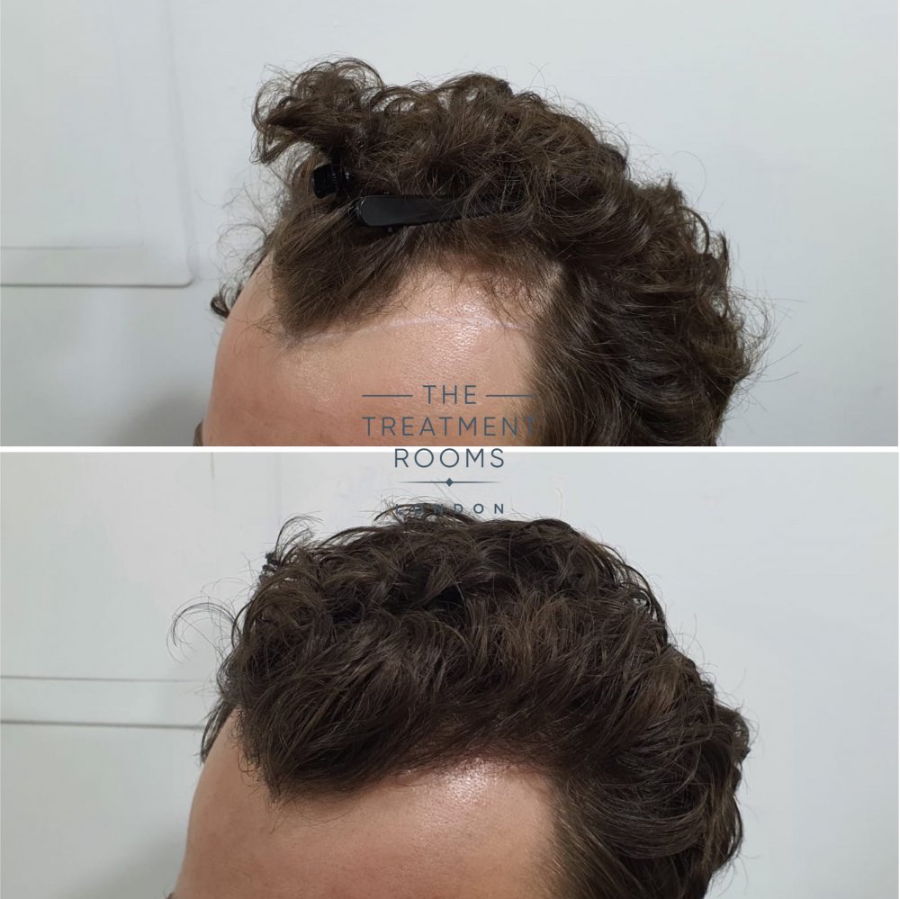 hair transplant curly hair.jpg