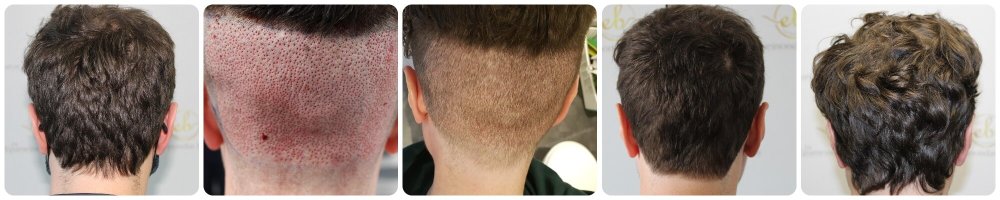 hair-transplant-donor-timeline.jpg
