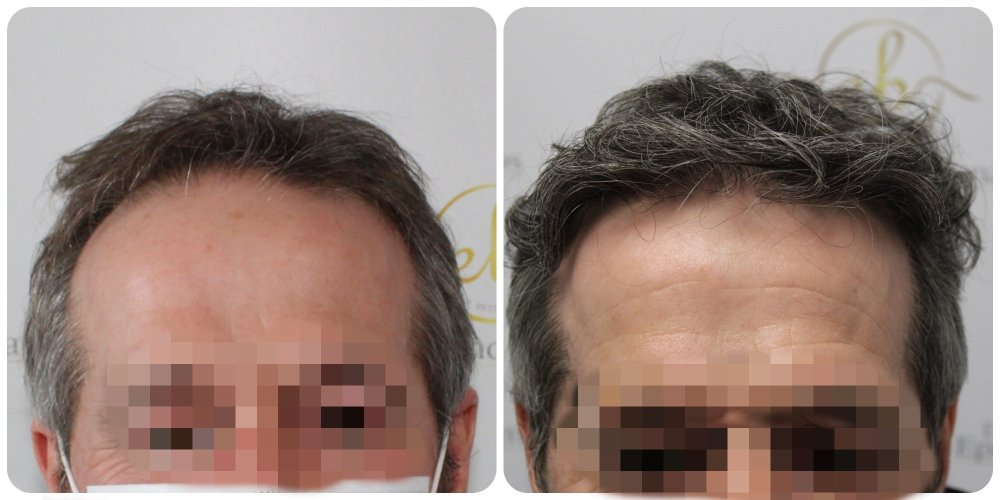 hair-transplant-dr-bonaros-glasgow-4000-grafts.jpg