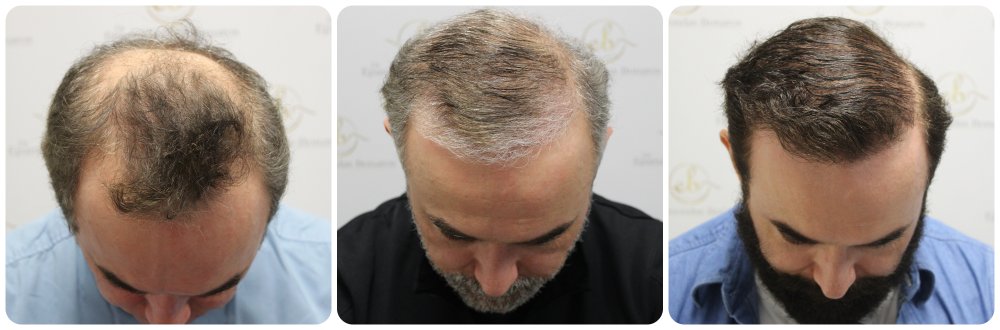 hair-transplant-dr-bonaros.jpg
