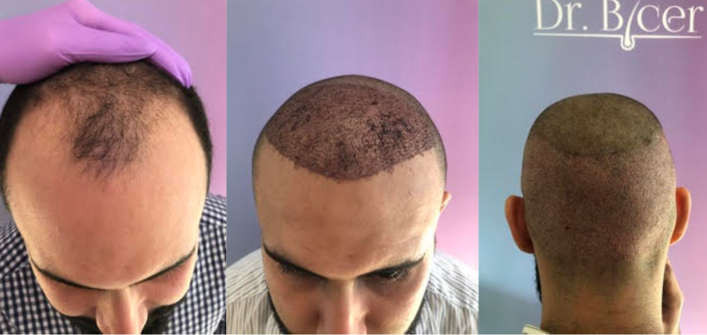 Hair Transplant Dr Ozlem Bicer Istanbul.png
