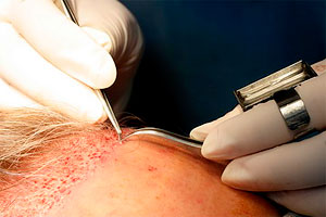 hair transplant forceps.jpg