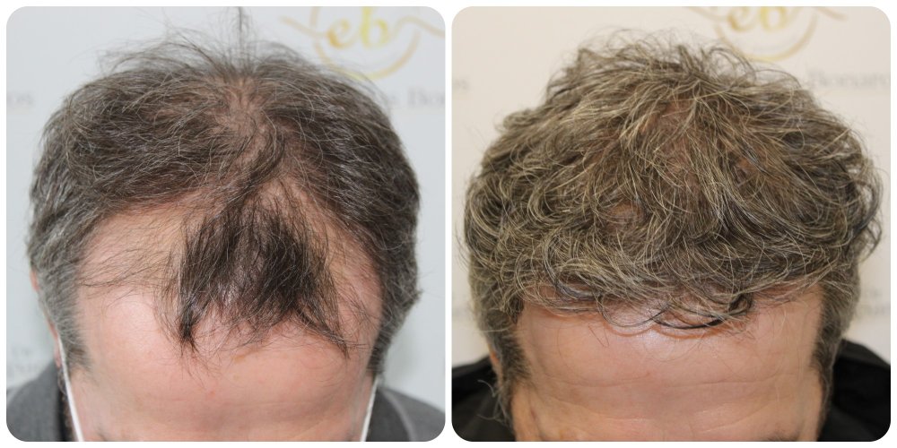 hair-transplant-fue-glasgow-fue.jpg.jpg