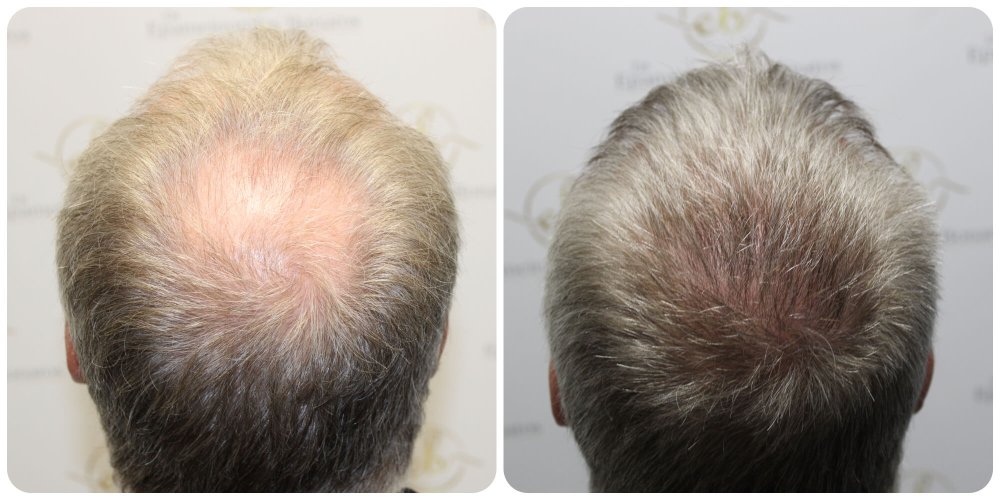 hair-transplant-fue.jpg