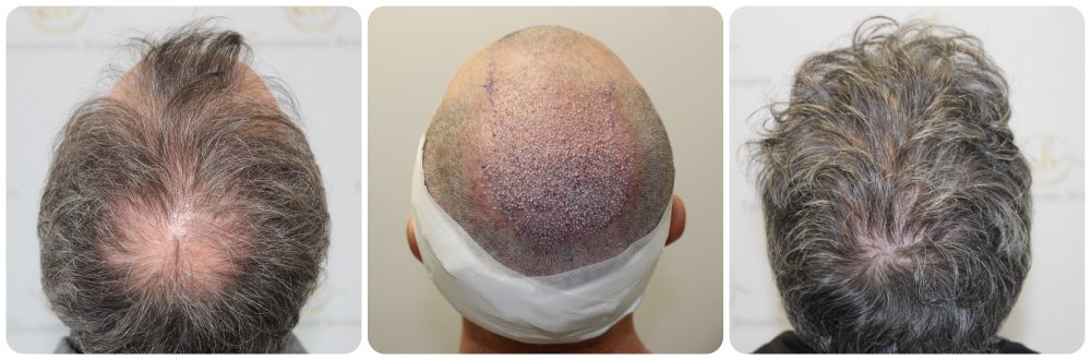 hair-transplant-glasgow-dr-bonaros-4000-grafts.jpg