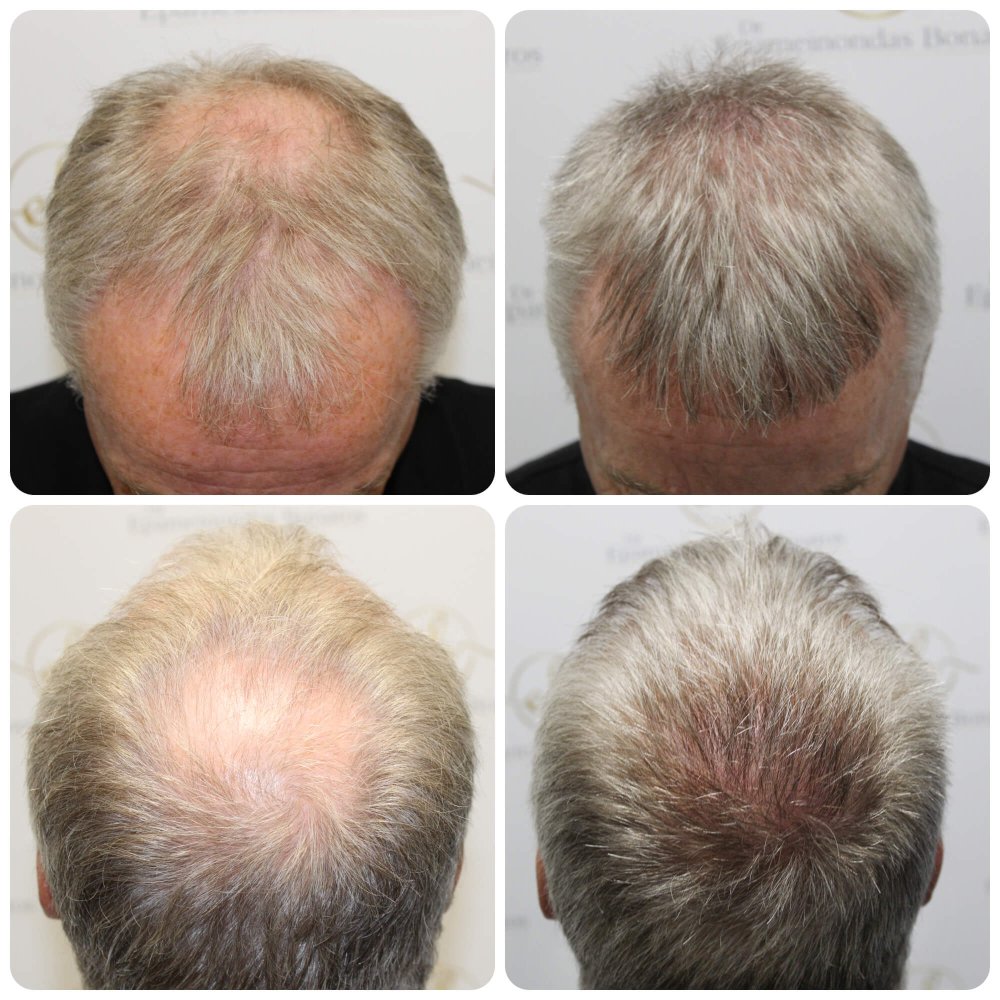 hair-transplant-glasgow-dr-bonaros (6).jpg