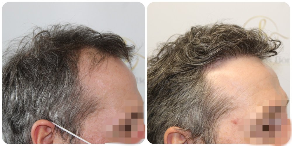 hair-transplant-glasgow-fue-4000-grafts.jpg.jpg