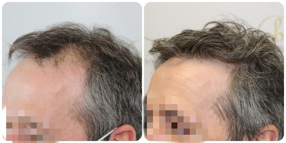 hair-transplant-glasgow-fue-dr-bonaros.jpg.jpg