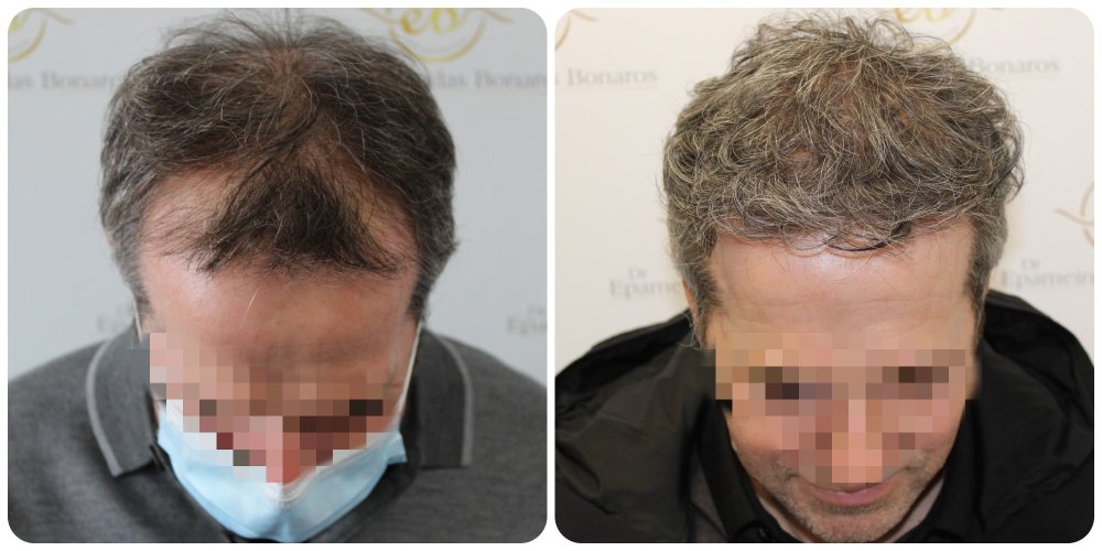 hair-transplant-glasgow-fue.jpg