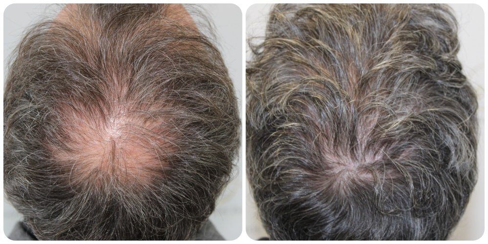 hair-transplant-glasgow-fue-scotland.jpg.jpg
