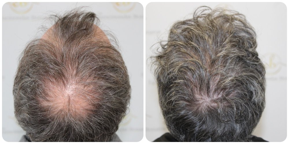 hair-transplant-glasgow.jpg.jpg