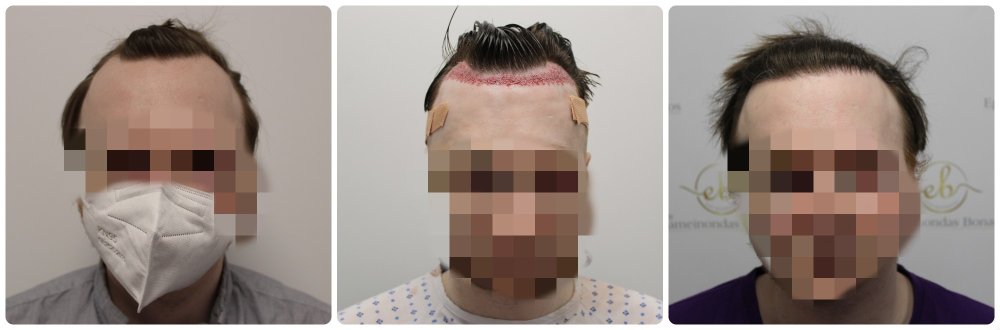 hair-transplant-glasgow.jpg