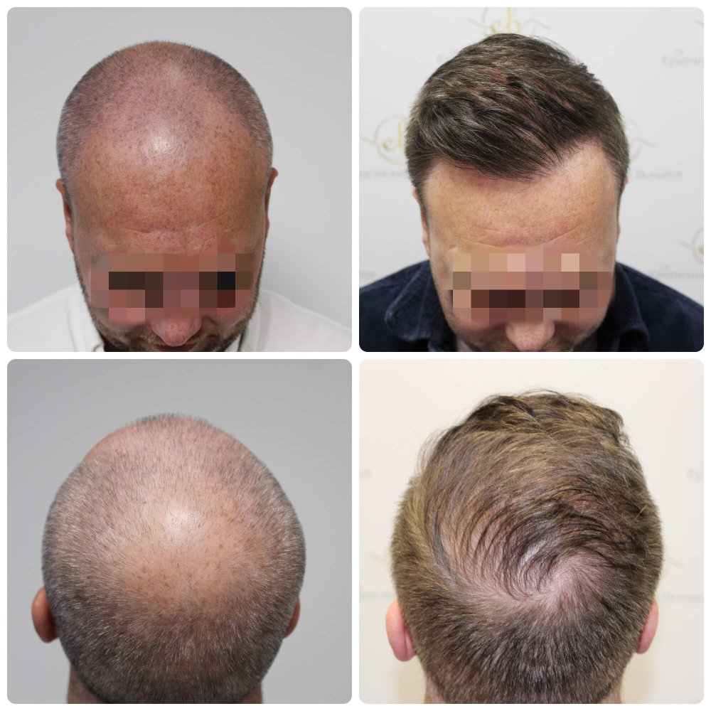 hair-transplant-glasgow.jpg