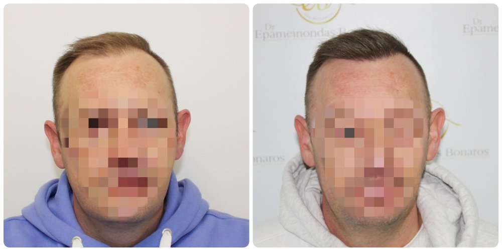 hair-transplant-glasgow-scotland-natural-hairline-before-after.jpg