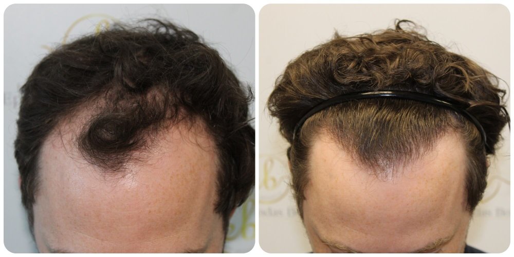 hair-transplant-glasgow-uk.jpg