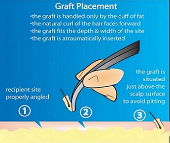 Hair transplant graft placement.jpg