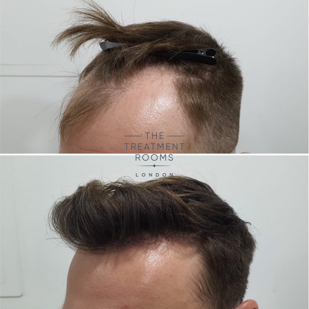 hair transplant hairline before and after 1724 grafts.jpg