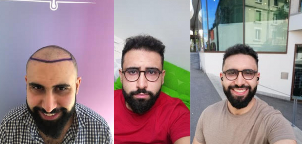 Hair transplant Istanbul Dr Bicer.png