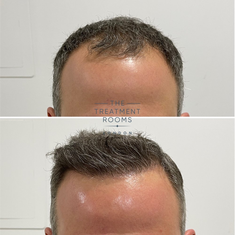 hair transplant london 1788 grafts before and after.jpg