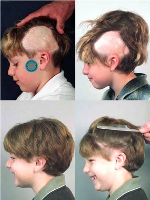 Hair Transplant on 11-year-old child fire victim 1.jpg