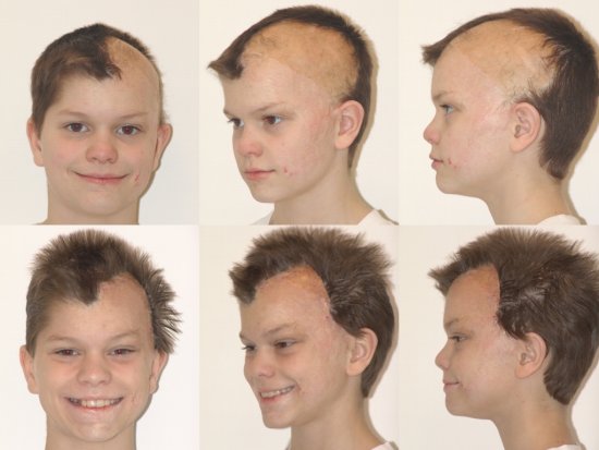 Hair Transplant on 11-year-old child fire victim.jpg