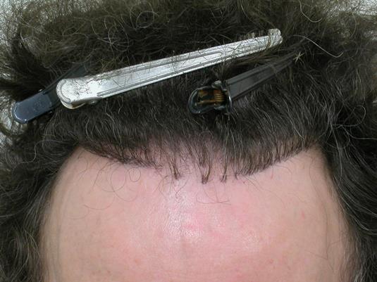 Hair Transplant pluggy hairline.jpg