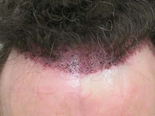 Hair Transplant pluggy hairline repair Bradley Wolf MD.jpg