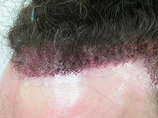 Hair Transplant pluggy hairline repair Bradley Wolf MD1.jpg