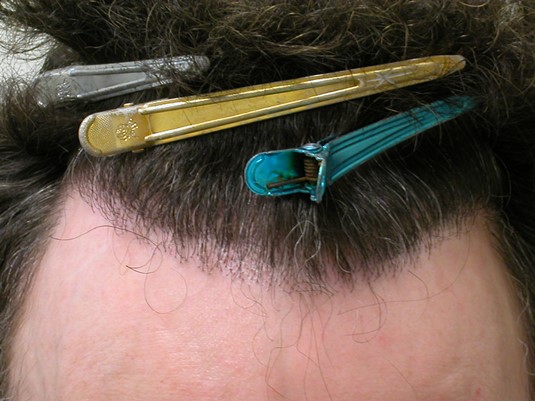 Hair Transplant pluggy hairline repair Bradley Wolf MD2.jpg