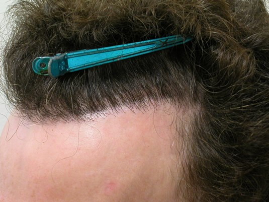 Hair Transplant pluggy hairline repair Bradley Wolf MD3.jpg