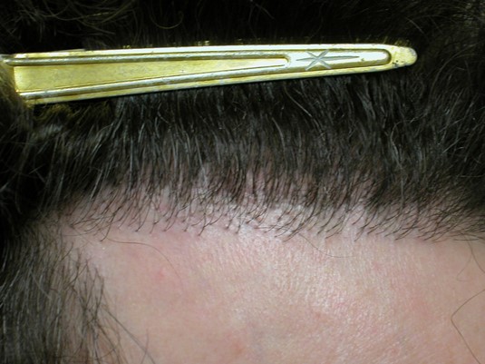 Hair Transplant pluggy hairline repair Bradley Wolf MD4.jpg