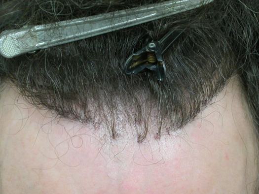 Hair Transplant pluggy hairline1.jpg