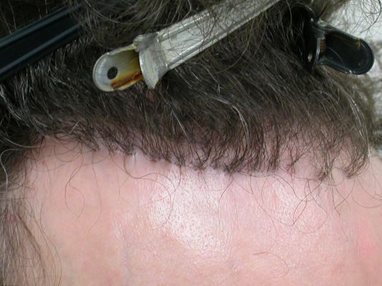 Hair Transplant pluggy hairline2.jpg