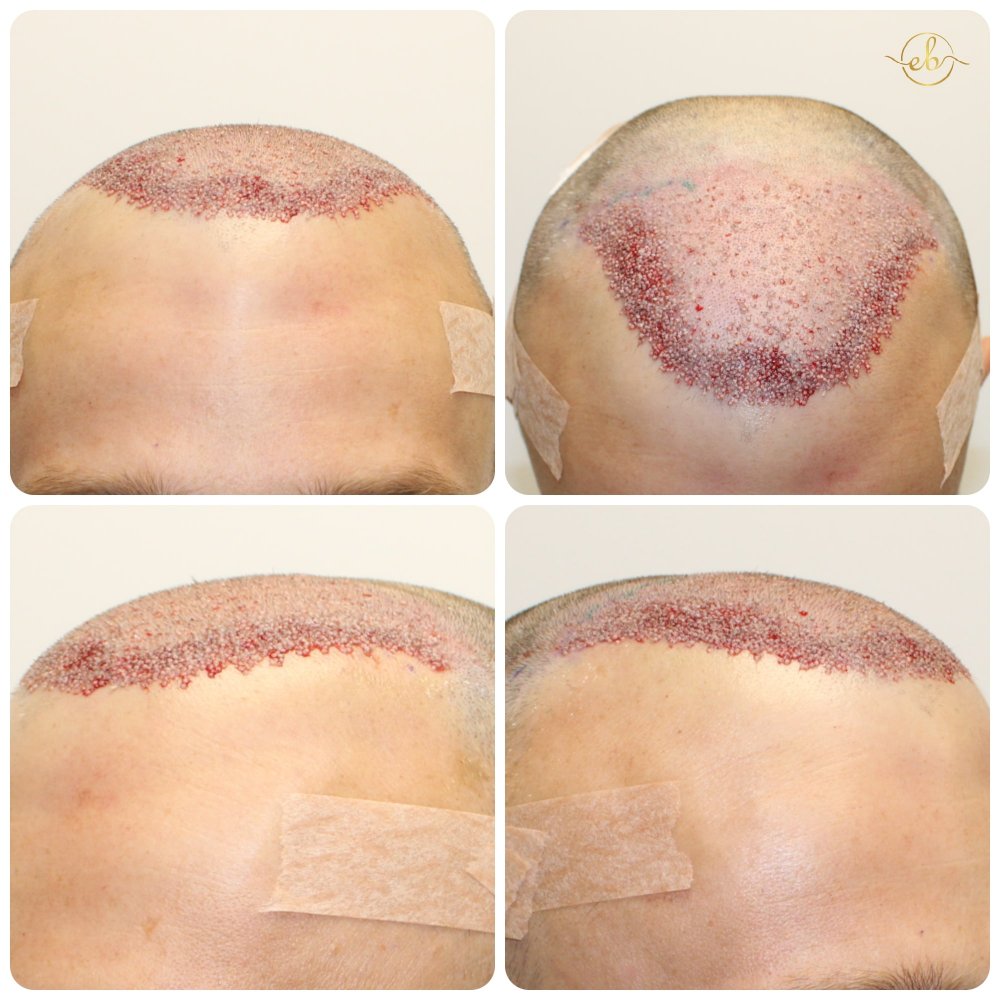 hair-transplant-procedure-receding -hairline-scotland.jpg