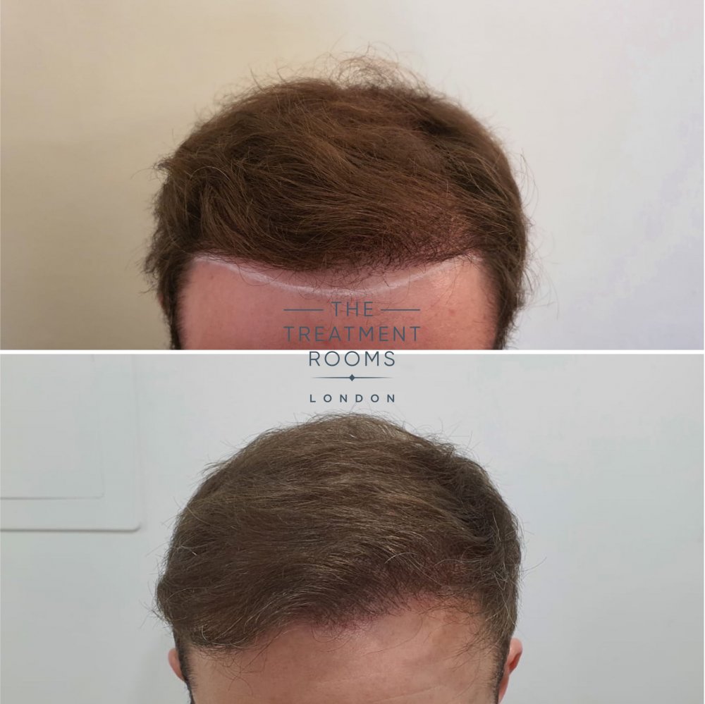 hair transplant repair.jpg