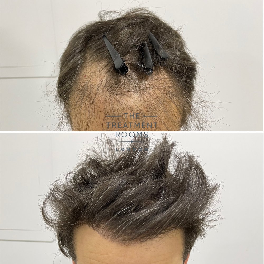 Hair transplant repair london.jpg