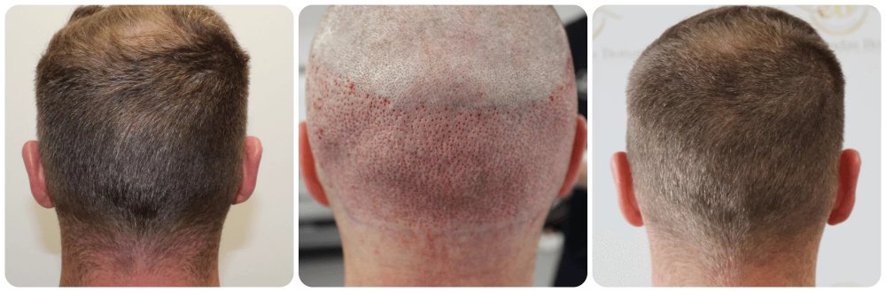 hair-transplant-result-dr-bonaros-donor-area.jpg