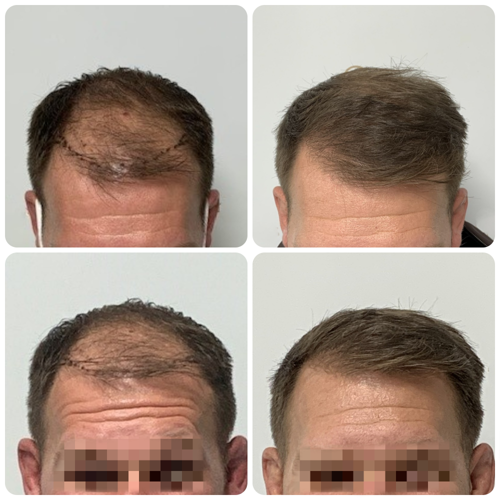 hair-transplant-result-dr-bonaros-glasgow-clinic.png