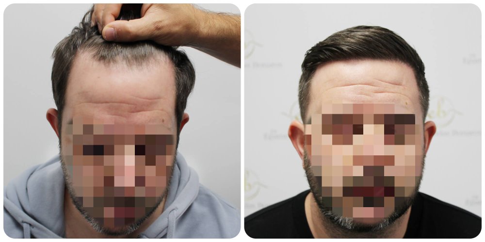 hair-transplant-result-glasgow-dr-bonaros (2).jpg