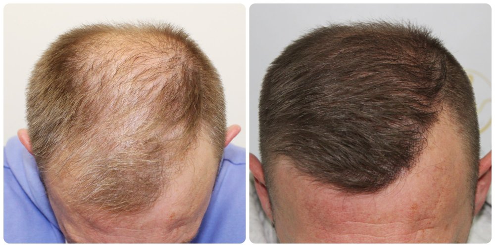 hair-transplant-result-glasgow-dr-bonarosclinic.jpg