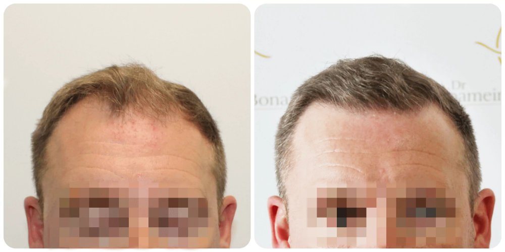 hair-transplant-results-dr-bonaros-glasgow-fue.jpg