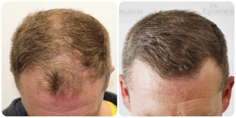 hair-transplant-results-dr-bonaros-glasgow-uk-fue.webp.jpg