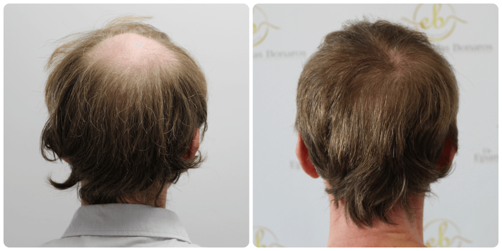 hair-transplant-results-dr-bonaros.png