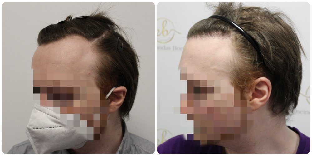 hair-transplant-scotland.jpg