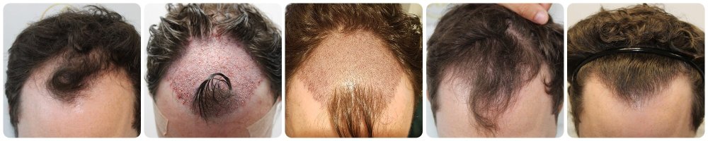 hair-transplant-timeline.jpg